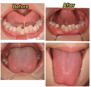 舌小帯の切除 目白駅の歯医者は目白ヶ丘デンタルクリニック矯正歯科