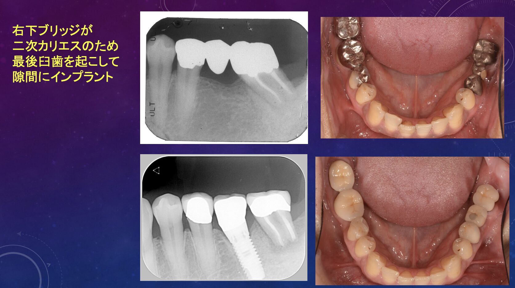 症例２：近心傾斜した最後臼歯のアップライト