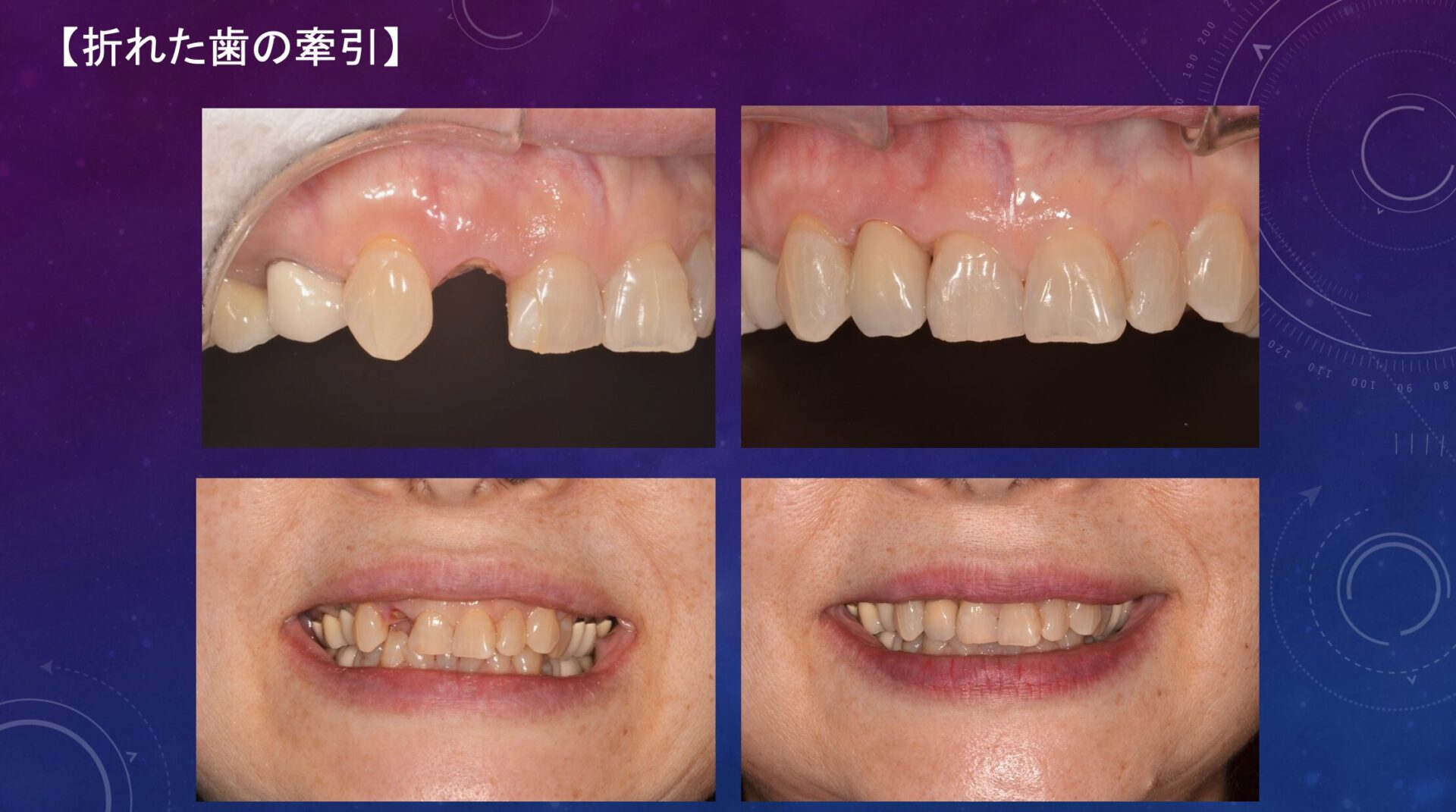 症例３：折れた前歯の根の牽引