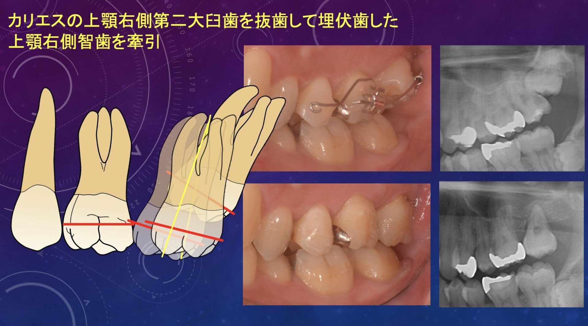 症例４：カリエスの上顎右側第二大臼歯を抜歯して埋伏した上顎右側智歯を牽引