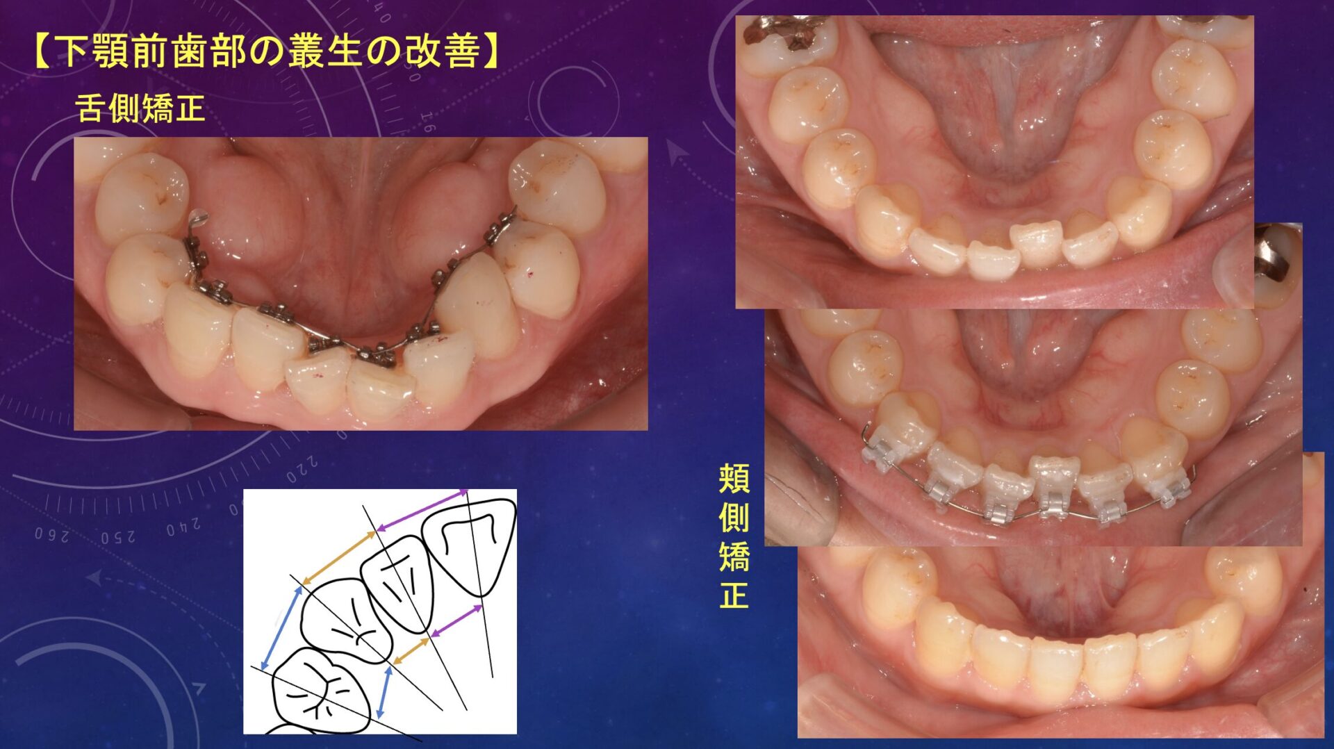 症例１：叢生の除去