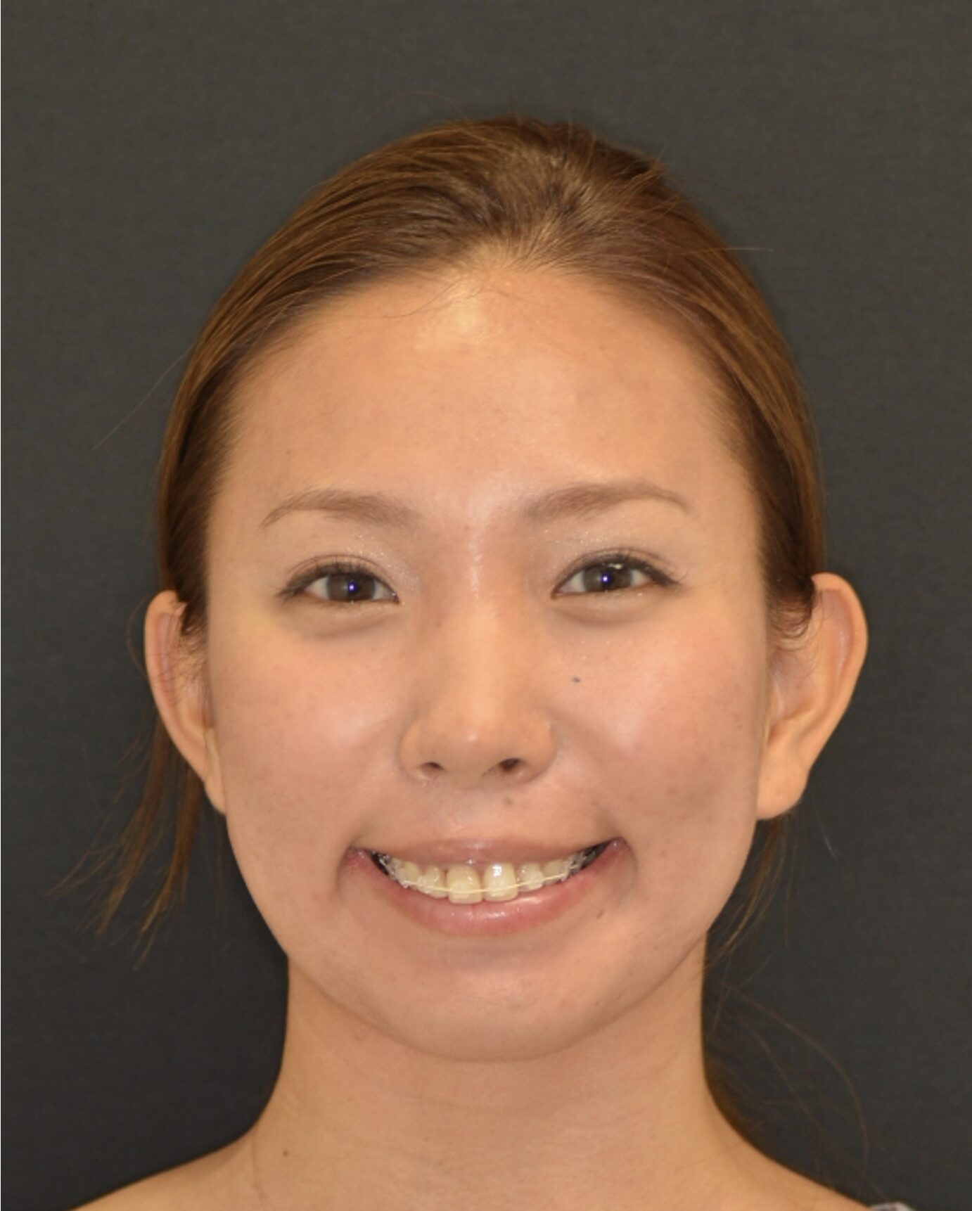 セラミックブラケットとホワイトワイヤーを装着した女性