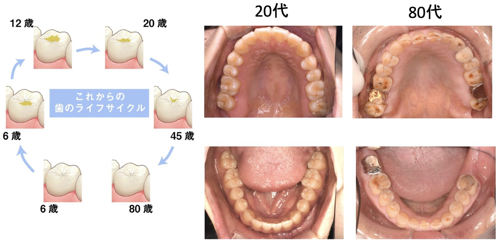 幼少期からのメインテナンスで80代でも自分の歯で食事ができる画像
