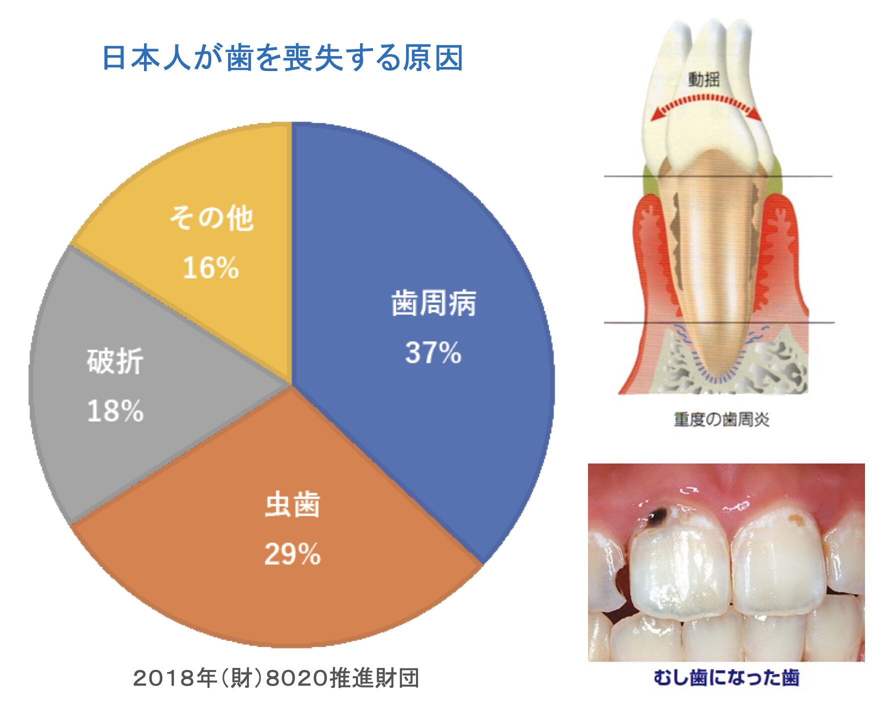 日本人が歯を失う原因