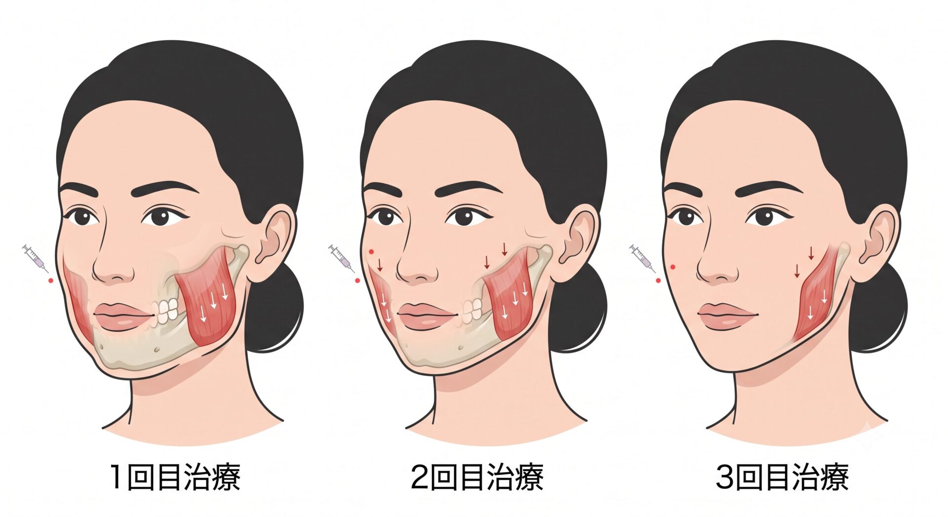 継続治療による咬筋のボリューム変化