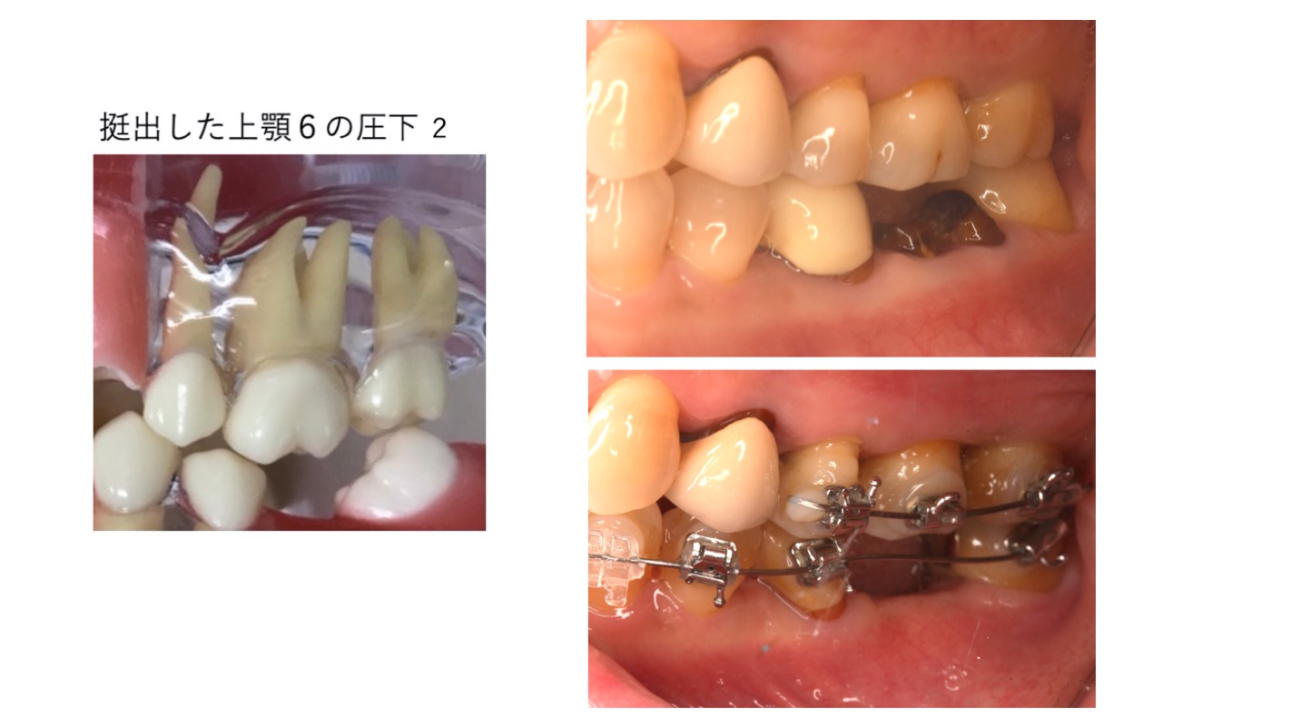 部分矯正実習内容8