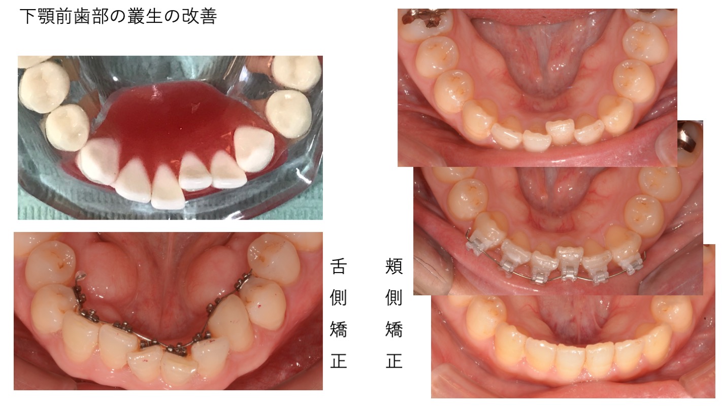 部分矯正実習内容2
