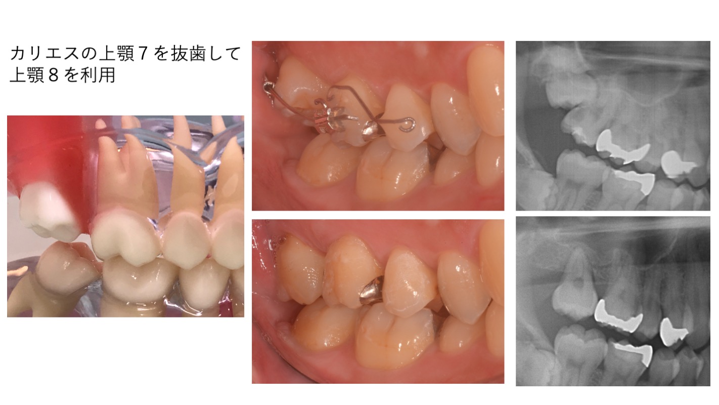 部分矯正実習内容1