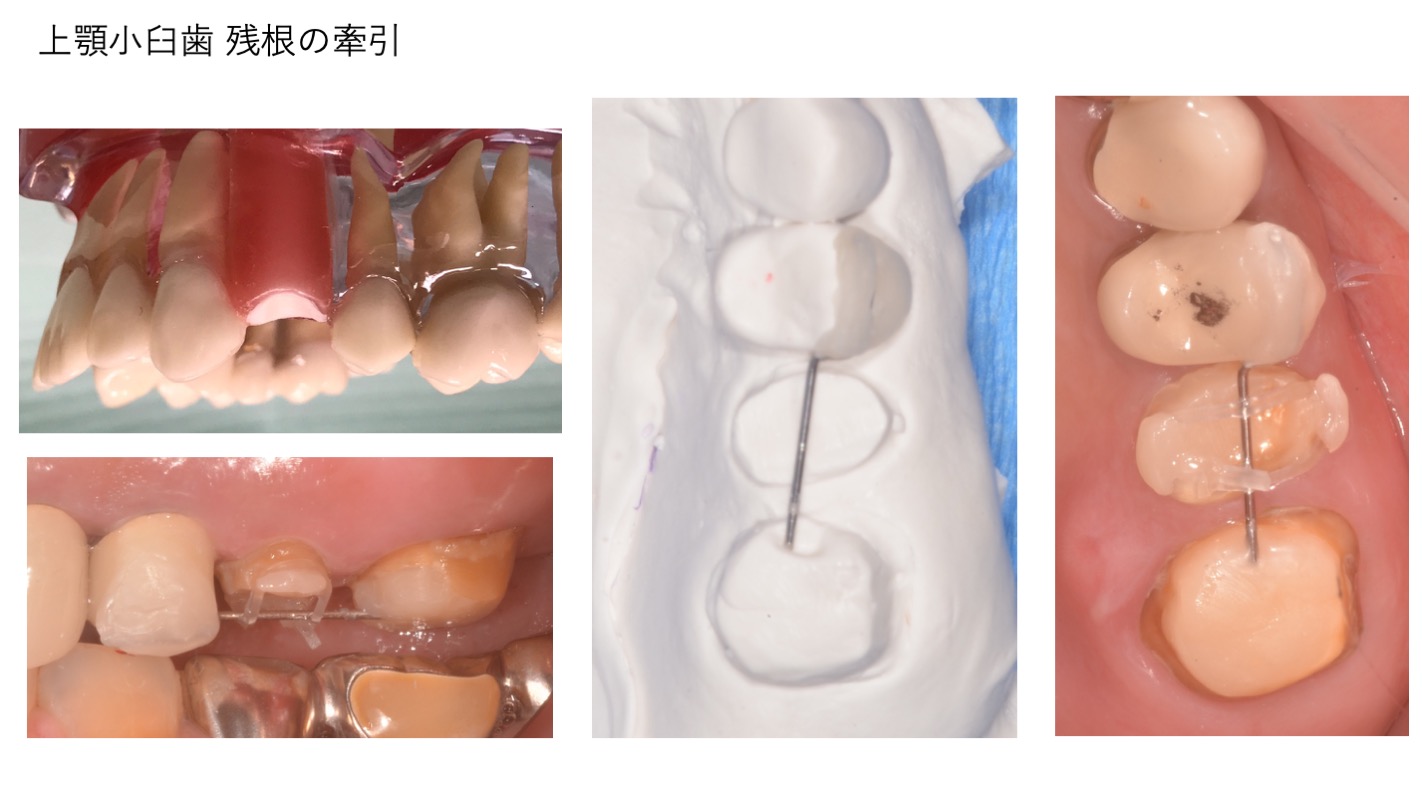 部分矯正実習内容4