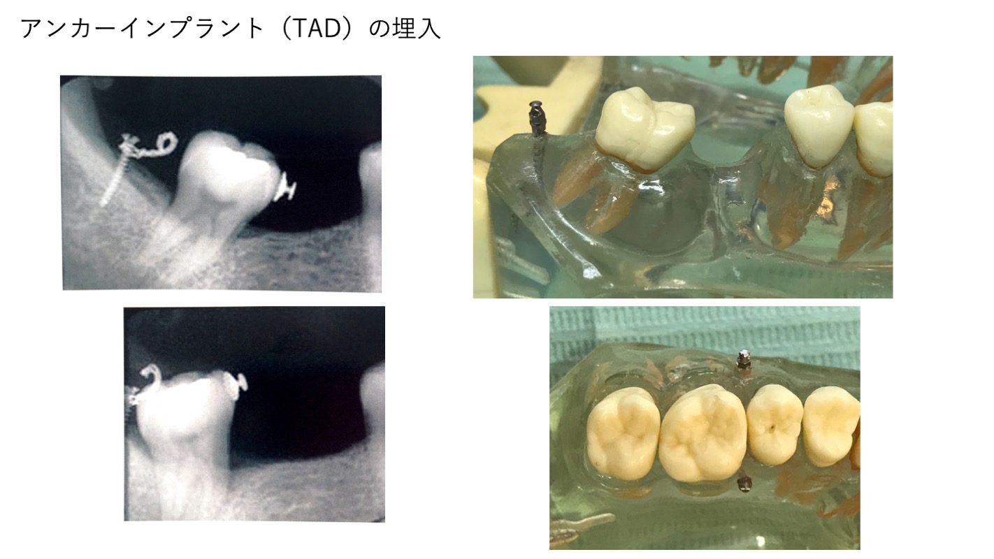 部分矯正実習内容6