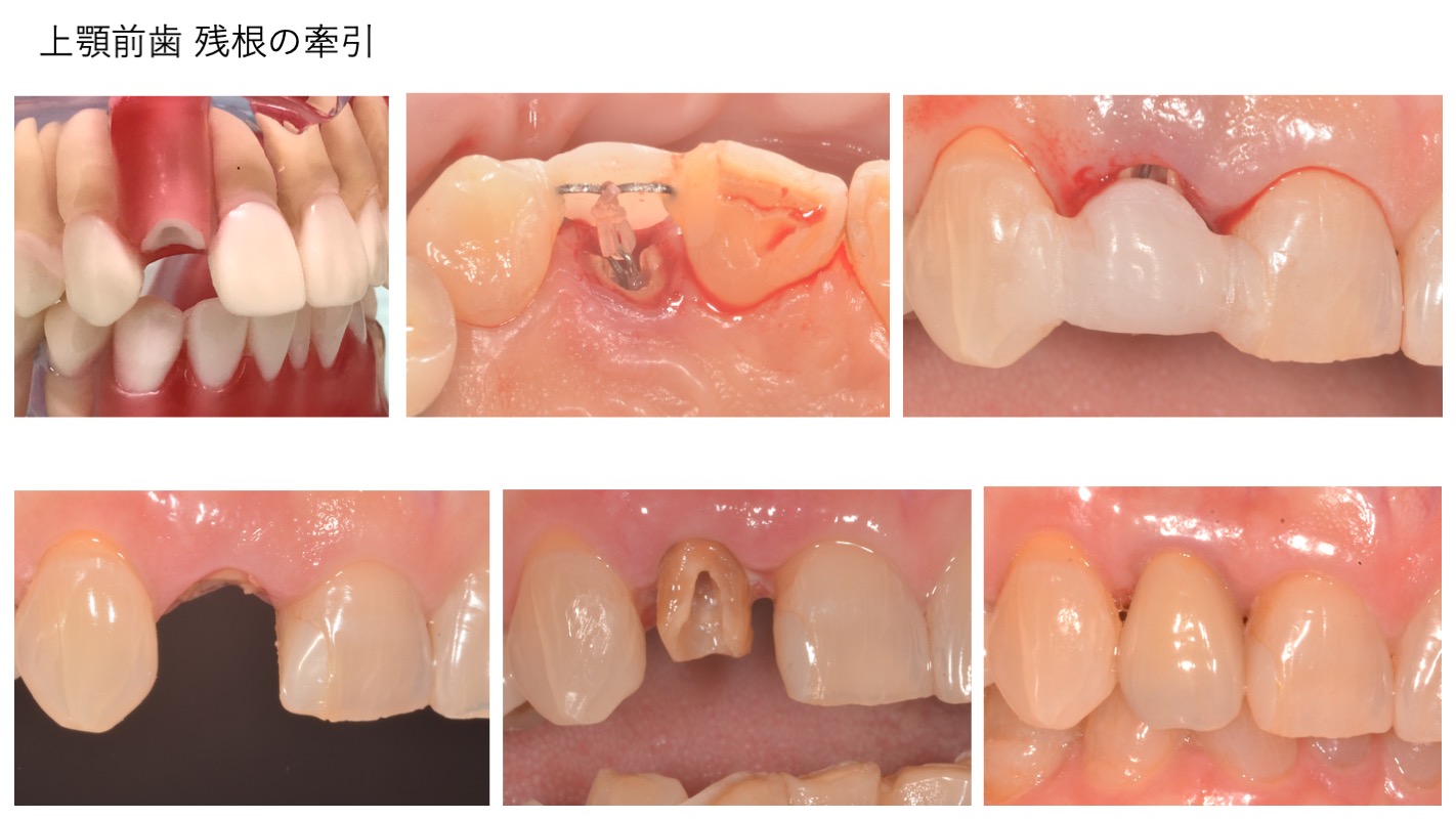 部分矯正実習内容3